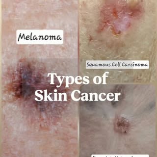 In Nathan's Skin,  we do 
1) Mole Mapping to identify if the mole is Melanoma or not.
2)Assessment o
