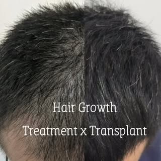After months of therapy combine with abit of hair transplant our patient of Norwood 4 is now Norwood