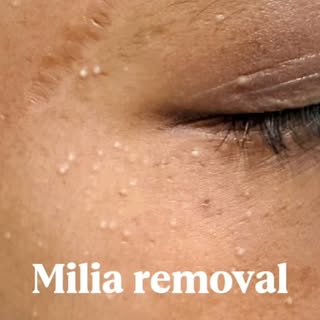 Milia, tiny white/yellow bumps that appear on the face, especially around the eyes, cheeks, and nose