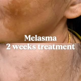 Melasma treatment for 2 weeks
Patient’s testimonial 
#dermatologists 
#drrubanskinguru 
#melasma
#pi