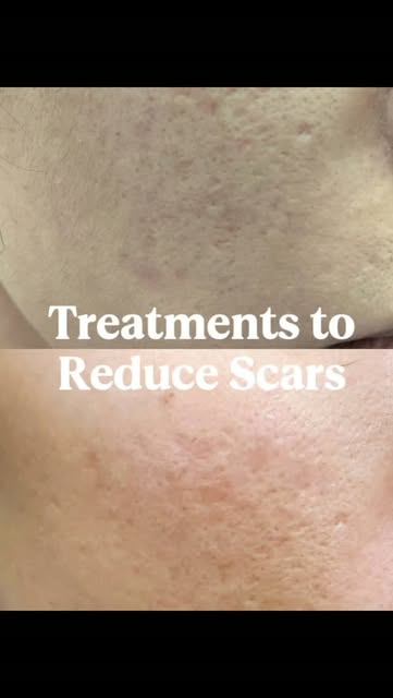 Treatments to reduce the appearance of scars
1. Virtue RF Microneedling
2. Fractional Laser
#scar 
#