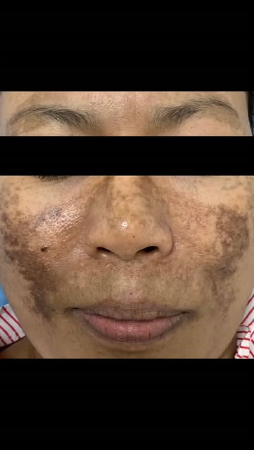 Melasma treatment
Dual Yellow Laser is gentle and non-ablative skin treatment that uses two precise 