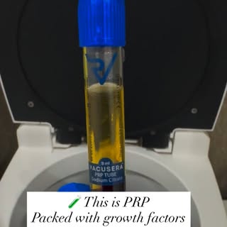 PRP Hair Restoration 🧬
Real science. ✔️
Real results. ✔️ 
Your own growth factors ✔️ 

Hair loss do