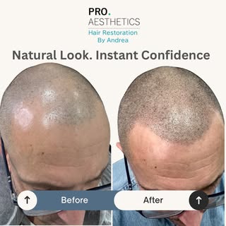 Hair loss has a way of following you everywhere.

You notice it in photos.

Under bright lights.

At