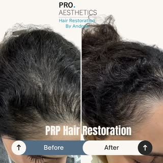The goal isn’t perfection. It’s looking in the mirror and seeing less scalp… and more YOU.

Female h