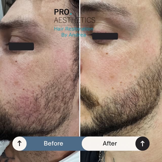 A beard transplant was the first step. PRP was the follow-up. 👏🏽

Four months after his transplant