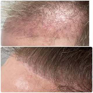 Look at that lovely thick hair 🤩

#prp #plateletrichplasma #essex #colchester #suffolk #london #hai