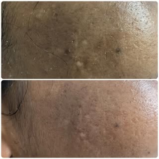 ✨ PRP Vampire Facial Results ✨

my client has already noticed a lighter appearance of dark pigmentat