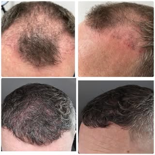 My client is 7 months post hair transplant combined with PRP treatments which is a powerful combinat