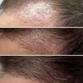 4 months post hair transplant + 2 PRP sessions so far.

PRP treatments are designed to support heali