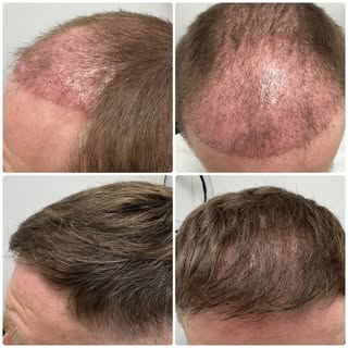 Few months Post hair transplant.
3 PRP sessions down.
Hair looking 🔥

Consistency + the right treat
