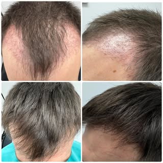 6 months on from his hair transplant + 4 PRP treatments… and look at that transformation 🔥 Density.