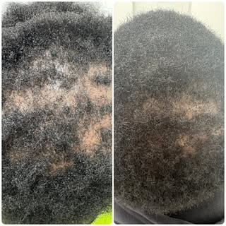 The power of PRP! 💉 These incredible results show great scalp coverage just one month after a singl