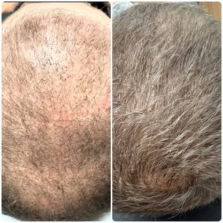 Only 2.5 months post hair transplant and one PRP treatment completed so far. The progress is already