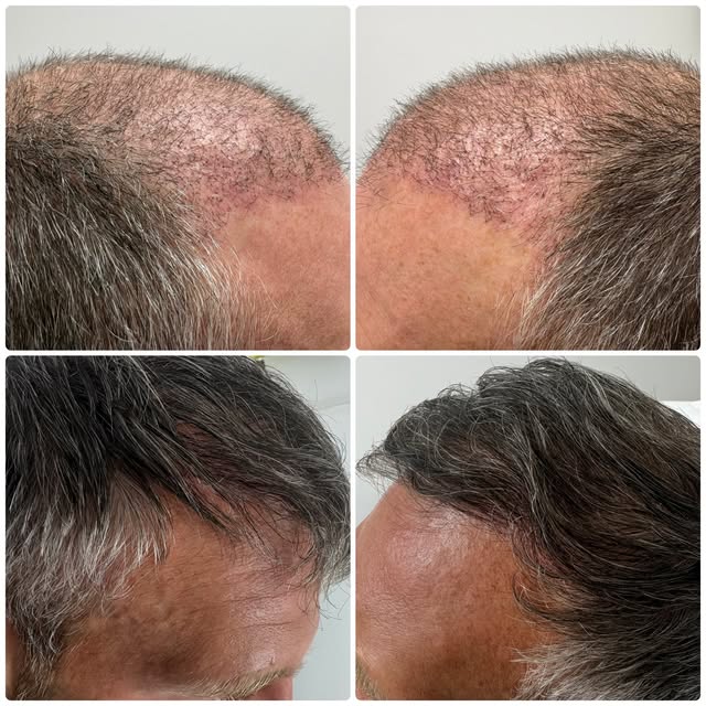 7 MONTHS POST HAIR TRANSPLANT ✨

A great example of how much can change with time, consistency and t
