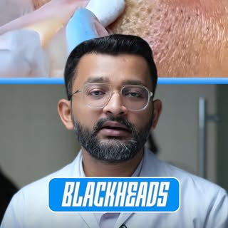 Stop squeezing your blackheads! 🛑 You are permanently damaging your skin!

Forcefully squeezing bla
