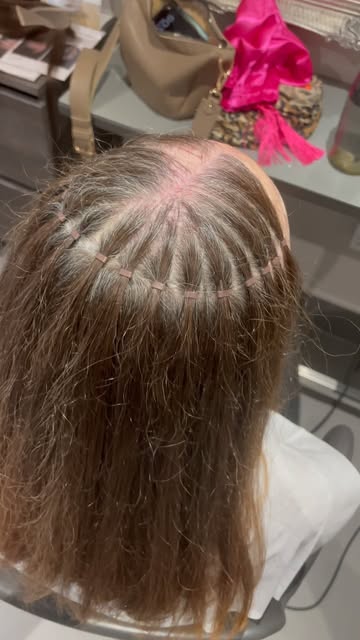 MESHLESS TRANSFORMATION ✨

A beautiful result for our client with Frontal Fibrosing Alopecia (FFA) a