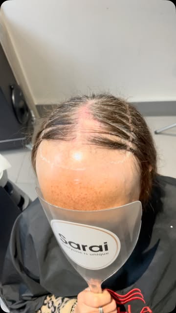 BESPOKE MESHLESS HAIR REPLACEMENT ✨

From the initial mapping to the finished result,  every detail 