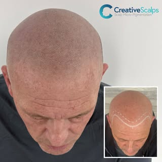 A soft, mature hairline — designed to age with him, not against him. 🖤 

Link in Bio to book your c
