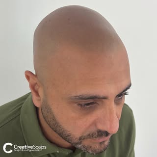 SMP Enhanced from an old SMP treatment Re-Worked the Shape of Hairline, Softened the edges and Gave 