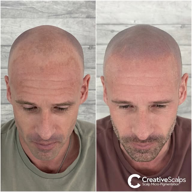 ✔️Hairline - Natural Shape & Finish with Faux Scar >> 
✔️Helping to camouflage some skin colour irre