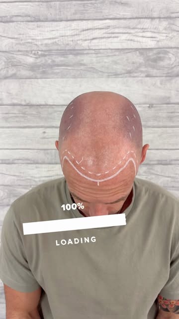 Loading …. A new version of you with SMP @creativescalps