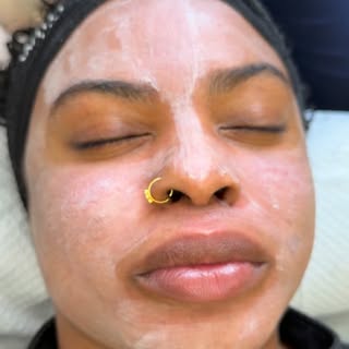 The Frost and Flake Peel is one of my favorite in office treatments to target cystic acne and all th