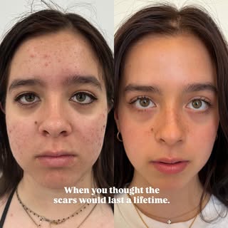 The scarring that comes with acne is far deeper than the skin’s surface. It affects the psyche, the 