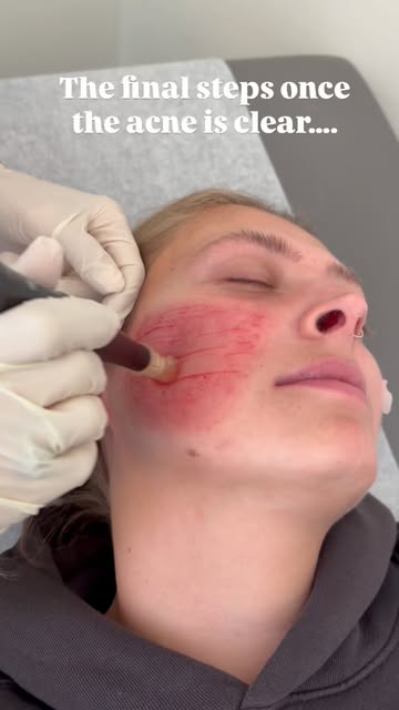 Once the acne is clear getting rid of the evidence is the next step. Microneedling with subcision is