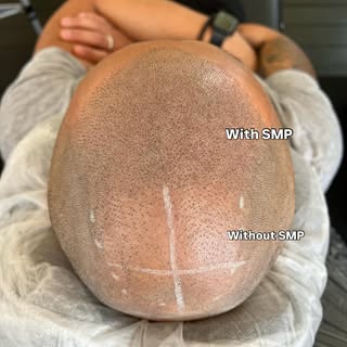 Camouflage hair loss — without surgery 

SMP provides results from the very FIRST session 

All resu