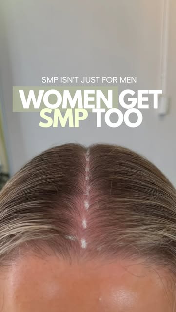 SMP ISN’T JUST FOR BALD MEN. 👀

One thing I wish more people knew is that women get Scalp Micropigm
