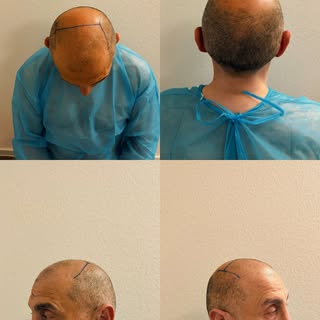 💯 Maximale Graft-Anzahl. Maximale Präzision. Maximales Vertrauen.

Jede Haartransplantation beginnt
