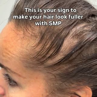 With SMP density treatment, we carefully add the appearance of tiny follicles between the existing h
