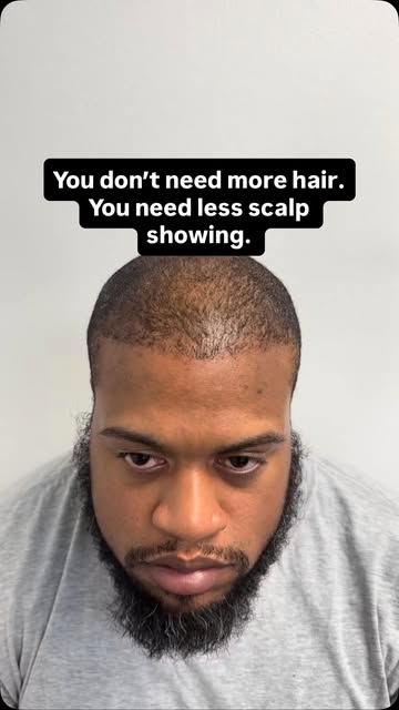 Same hair. Way less scalp showing.

Density SMP is all about reducing the contrast between the hair 