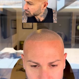 3 sessions. No surgery. No transplant. Just the look of a fuller, natural hairline. 

SMP creates th