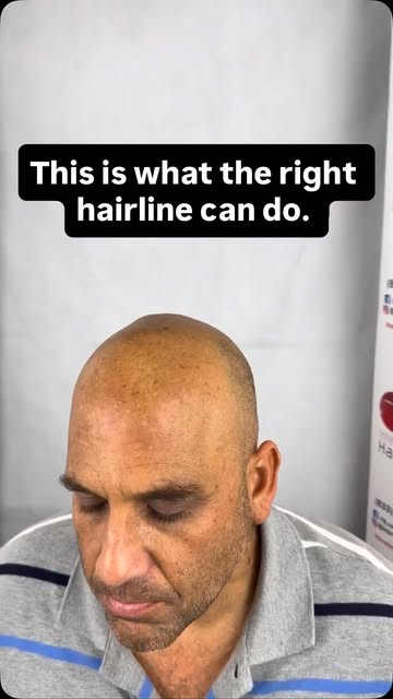 Some see it as a new hairline. We see it as bringing back the person you recognize in the mirror. 

