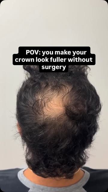 If your crown is thinning, surgery isn’t the only option.

SMP can create the appearance of more den