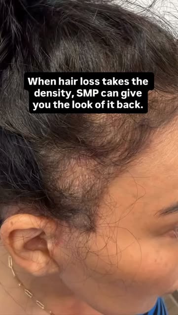Hair loss can change the way the scalp looks long before all the hair is gone. As density decreases,