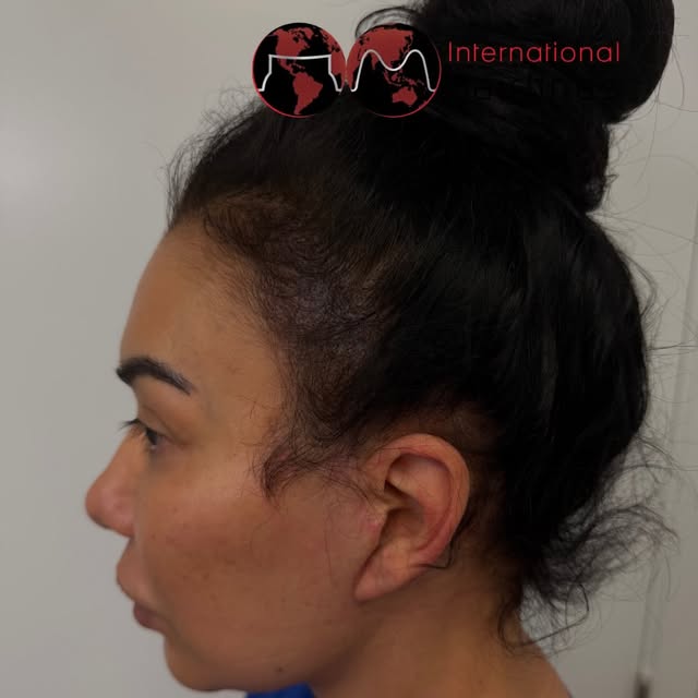 The main focus here was camouflaging the facelift scar around the hairline and making it blend natur