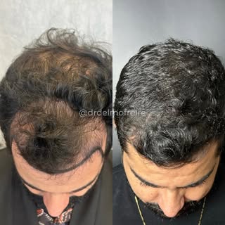 Antes e depois de um Transplante Capilar FUE com apenas 9 meses de evolução. Já se observam ótimos r