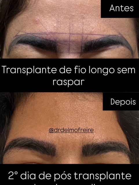 Transplante de sobrancelhas com fio longo sem raspar.