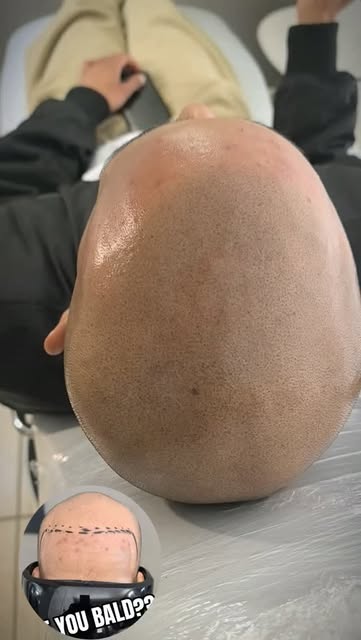 Most Natural-looking result guarantee!! 🇿🇦💯👌👌

#fyp #scalpmicropigmentation #southafrica #hairt