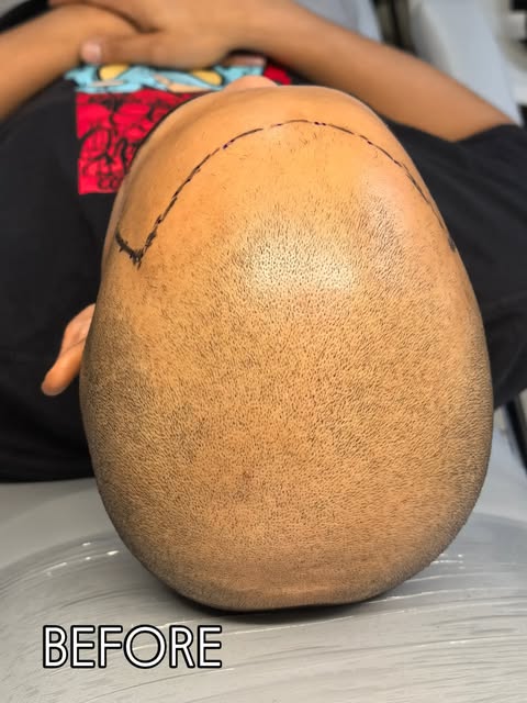 A natural transformation begins with the first session. ✨ This scalp micropigmentation treatment was