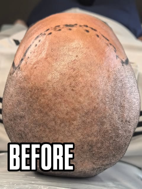 Scalp Micropigmentation is more than just adding pigment to the scalp — it’s about restoring confide