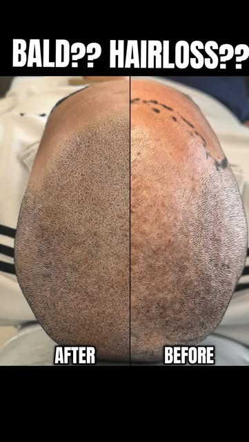 Have you heard about Scalp Micropigmentation (SMP)? 👀
SMP is a non-surgical hair-loss solution that