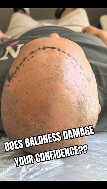 Ready to transform the way you see yourself? Scalp Micropigmentation creates the appearance of natur