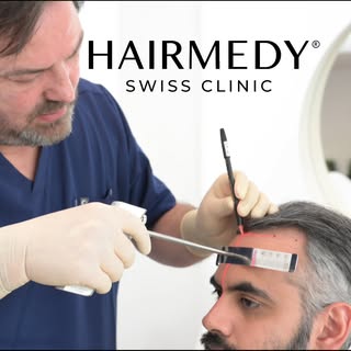 Von der ärztlichen Beratung zum 10-Tage-Ergebnis🔥 #hairtransformation #hairtransplantation #natural