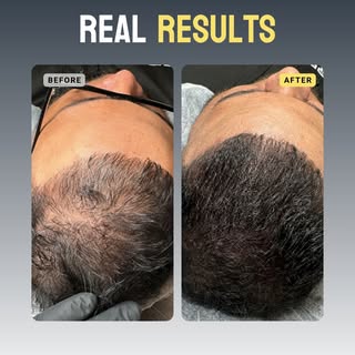 Last month, a client walked in with a receding hairline that had bothered him for years.

We started