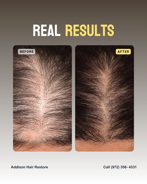 Struggling with hair loss that seems impossible to stop? You've tried shampoos, supplements, and hom