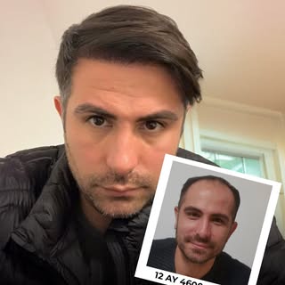 A fresh start, a stronger look!
Another happy patient completes their hair transplant journey with D